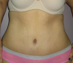 Manhattan abdominoplasty after 3